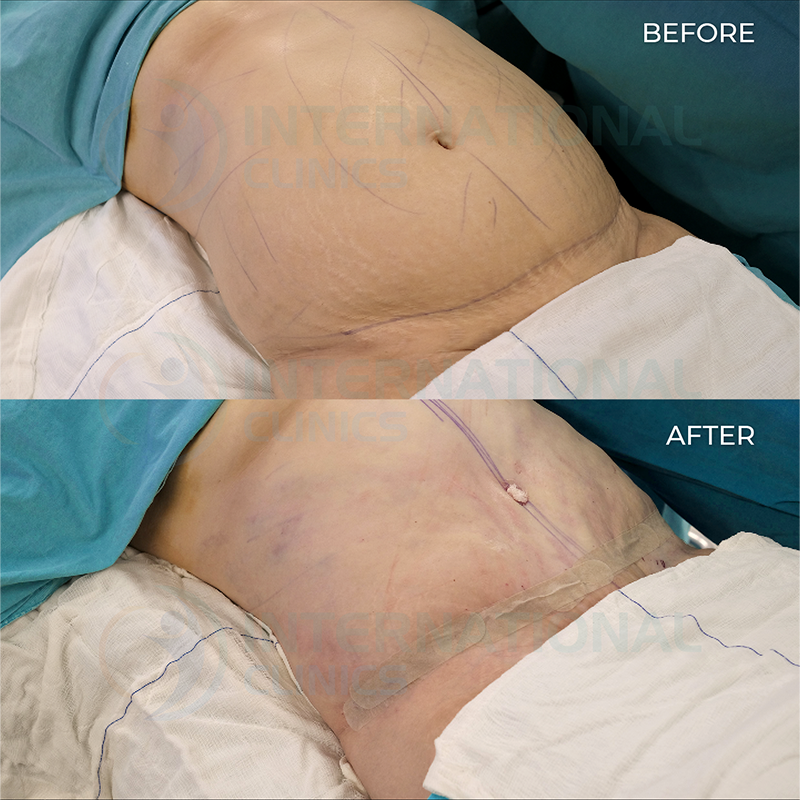 Mini Tummy Tuck before and after 